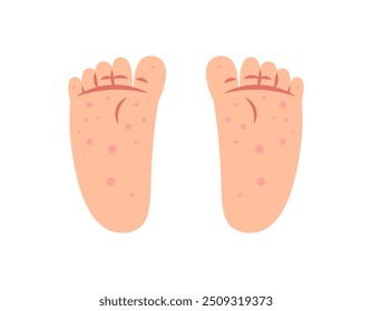 illustration of two soles of feet covered with rashes and wounds. red spots on feet. symptoms of Singapore flu or chicken pox. foot and skin diseases. health problems. flat style design. element