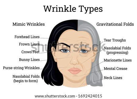 Illustration of two types of wrinkles, such as mimic and gravitational