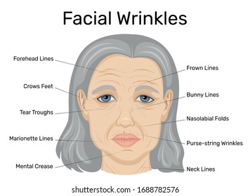 Illustration of types of wrinkles on the face of an old woman