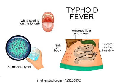 Typhoid Fever Diet Chart In Hindi