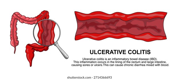 Ilustración de colitis ulcerosa, enfermedad inflamatoria intestinal. Inflamación del sistema digestivo humano. Ilustración vectorial para carteles médicos, científicos, infográficos y educativos.