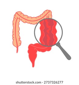 Illustration of ulcerative colitis, inflammatory bowel disease. Inflammation of the human digestive system. Flat vector illustration for medical, science, and educational posters.