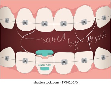 Illustration Of Using Dental Floss For Teenagers With Braces