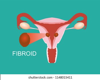 Illustration Of The Uterine Fibroid, Womb Anatomy