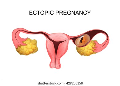 illustration of uterus with ectopic pregnancy. gynecology