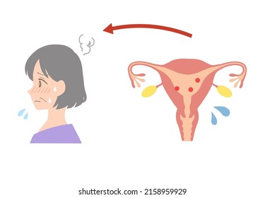 Illustration Of The Uterus Of A Low Estrogen, Perimenopausal Middle-aged Woman.