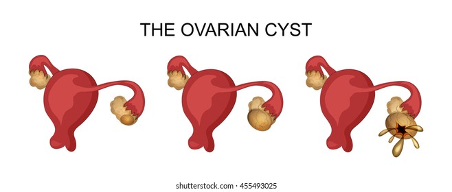 Illustration Of The Uterus And Ovaries And Ovarian Cysts
