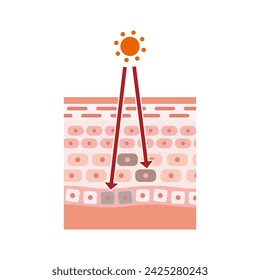 Illustration von UV-Strahlen und Hautstruktur erklären Sonnenbrand Mechanismus (flach)