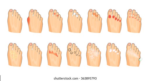 illustration of the various foot damage, inflammations