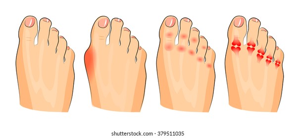 illustration of the various injuries of the feet. inflammation and arthritis