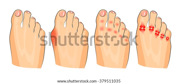 Illustration Various Injuries Feet Inflammation Arthritis Stock Vector ...