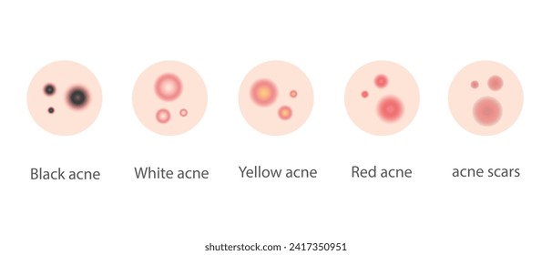 Ilustración de varios tipos de acné para diseño web y banners.