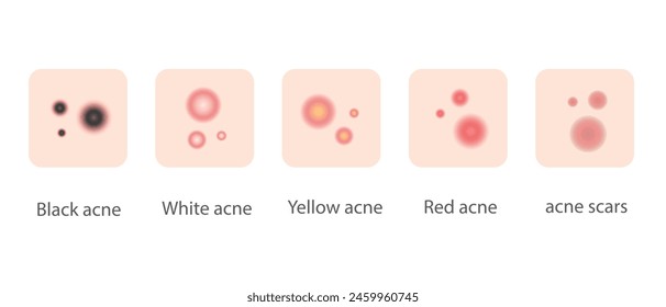 Ilustración de varios tipos de acné para Diseño web y Anuncios.