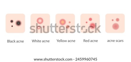 Illustration of various types of acne for web design and banners.
