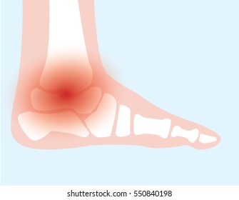 illustration vector of ankle bone and joint pain