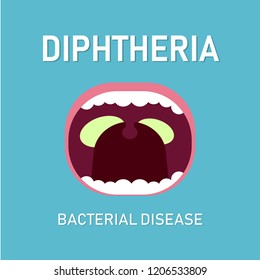 Illustration Vector: Diphteria bacterial disease, medical concept