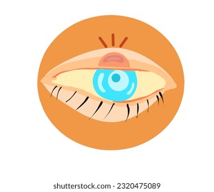 Illustrationsvektor, menschliches Auge mit geschwollenem Augenlider. Blepharitis.