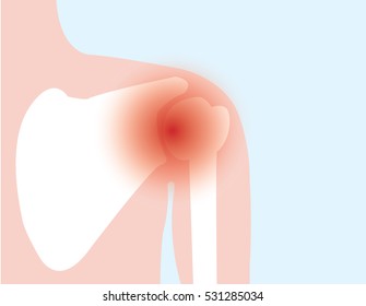 Illustration Vector Of Shoulder Bone And Joint Pain