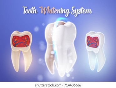 Illustration of Vector Teeth Cleaning Process. 3D Realistic Vector Teeth Whitening Process