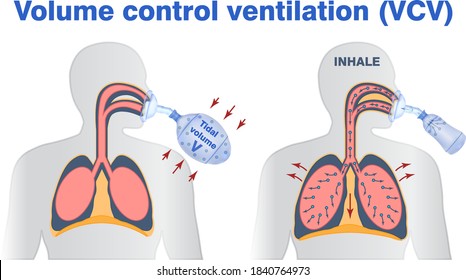 Illustration of vollume control or support artifitial ventilation. Tidal volume, mask ventilation, breathing resuscitator bag ventilation.