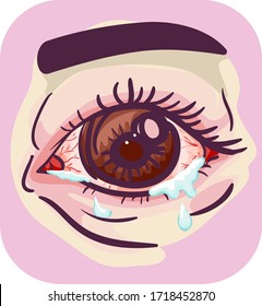 Illustration of Watery and Itchy, Red, Dry Eye