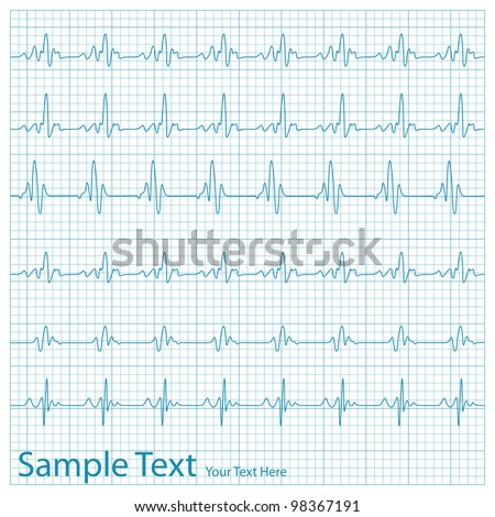 illustration of wave form on checked ecg graph