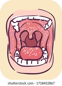 Illustration of Wide Opened Mouth with Oral Thrush Symptom of HIV