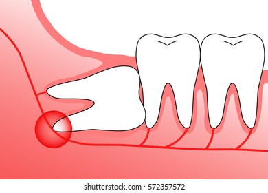 Illustration of wisdom teeth and nerves