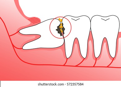 Illustration of wisdom teeth and nerves