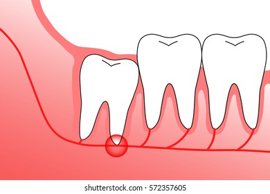 Illustration of wisdom teeth and nerves