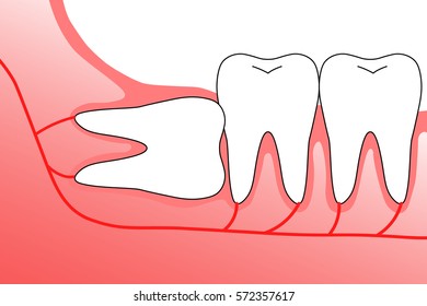 Illustration of wisdom teeth and nerves