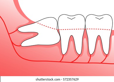 Illustration of wisdom teeth and nerves