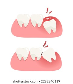 Illustration of wisdom tooth under gum cause of pain and lean on other teeth cause of tooth decay. Concept of pain in mouth, toothache, impacted tooth, oral and dental health, dentistry. Flat vector.