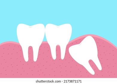 Illustration of wisdom tooth.Dental concept