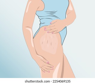 illustration. A woman after weight loss shows stretch marks on the skin of her legs and the outer and inner side of the thighs. Treatment of skin stretch marks in the clinic.