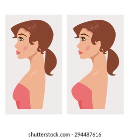 Illustration of a woman with breast before and after mammoplasty