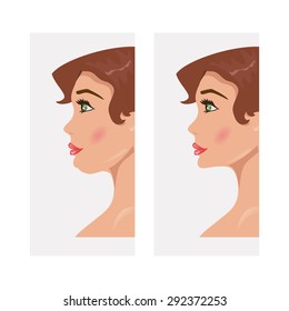 Illustration of a woman with a double chin and a normal chin surgery