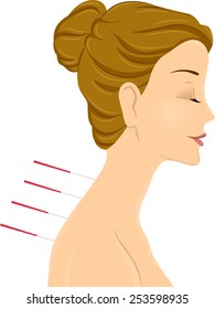Illustration of a Woman Getting an Acupuncture Treatment