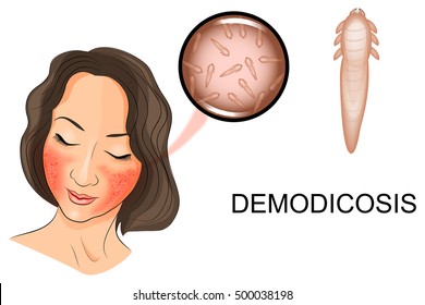 illustration of a woman's face affected by demodicosis. Demodex mite under magnification
