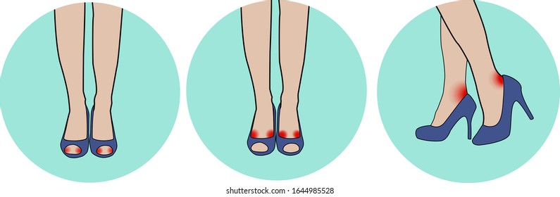 Illustration of a woman's legs in shoes with possible places for the appearance of corns