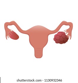 Illustration of the womb with a polycystic ovary