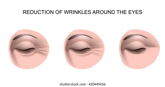 Illustration For The Wrinkles Around The Eyes