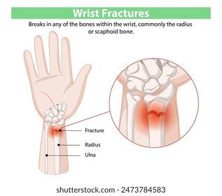 Illustration of wrist fractures and affected bones