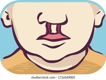 Illustration of a Young Face with Bilateral Cleft Lip