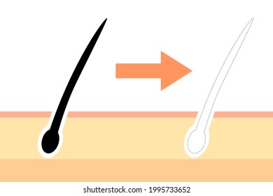 Illustrations about hair loss. Vector illustration.
