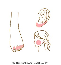 Illustrations of areas where chilblains often occur (feet, ears, cheeks)