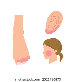 Illustrations of areas where chilblains often occur (feet, ears, cheeks)