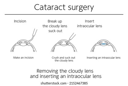 Illustrations, Cataract surgery, Medical Illustrations.
