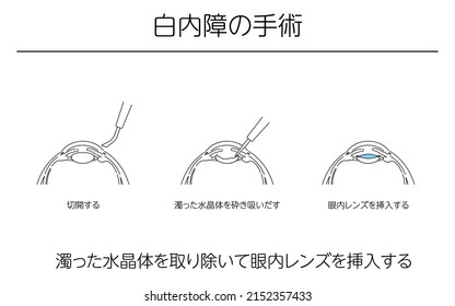 Illustrations, Cataract surgery, Medical Illustrations. - Translation: cataract surgery, removing a cloudy lens and inserting an intraocular lens, making an incision, crushing and sucking out the clou