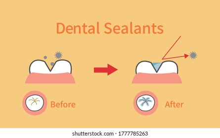 illustrations of dental sealants treatment before after